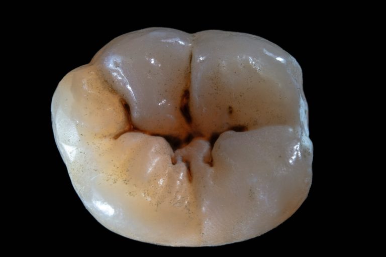 Sealants and Fillings